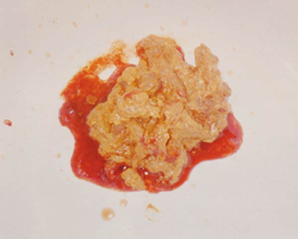 赤痢アメーバ症について｜性病専門のあおぞらクリニック新橋院