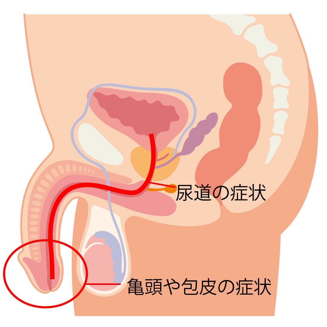 画像 カンジタ 男性 男性のカンジダ 症状・原因