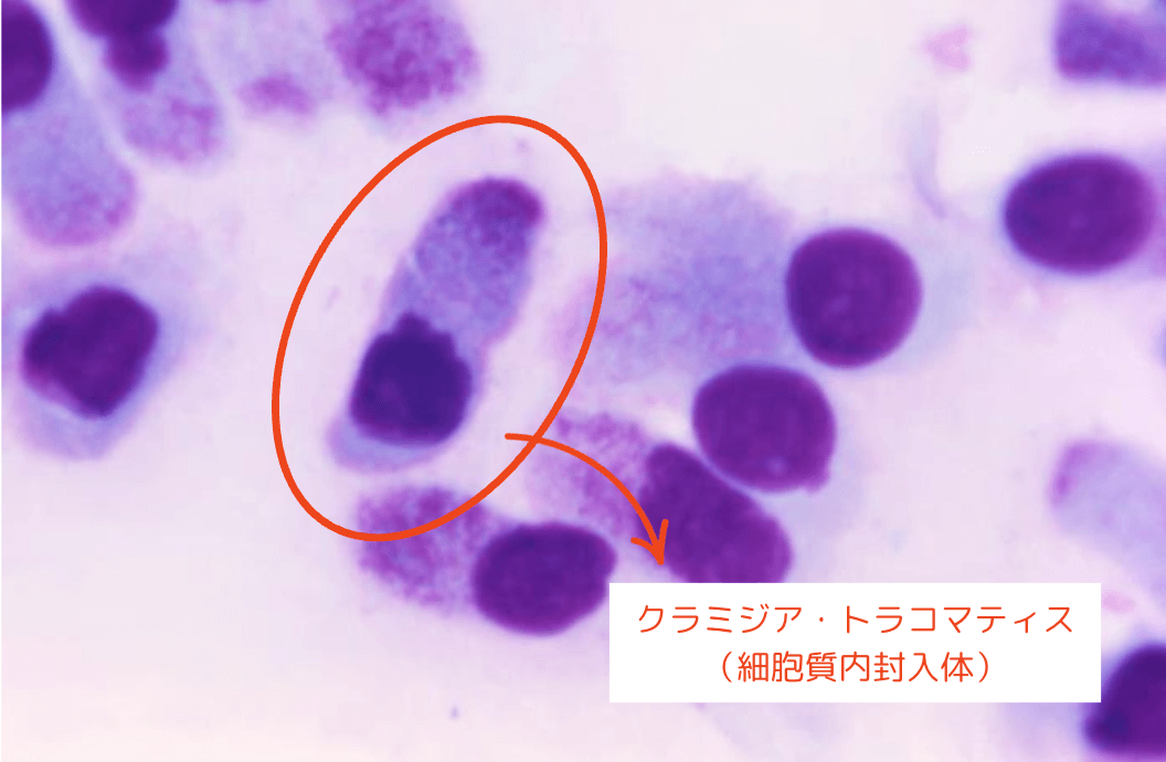 クラミジア・トラコマティス（細胞質内封入体）