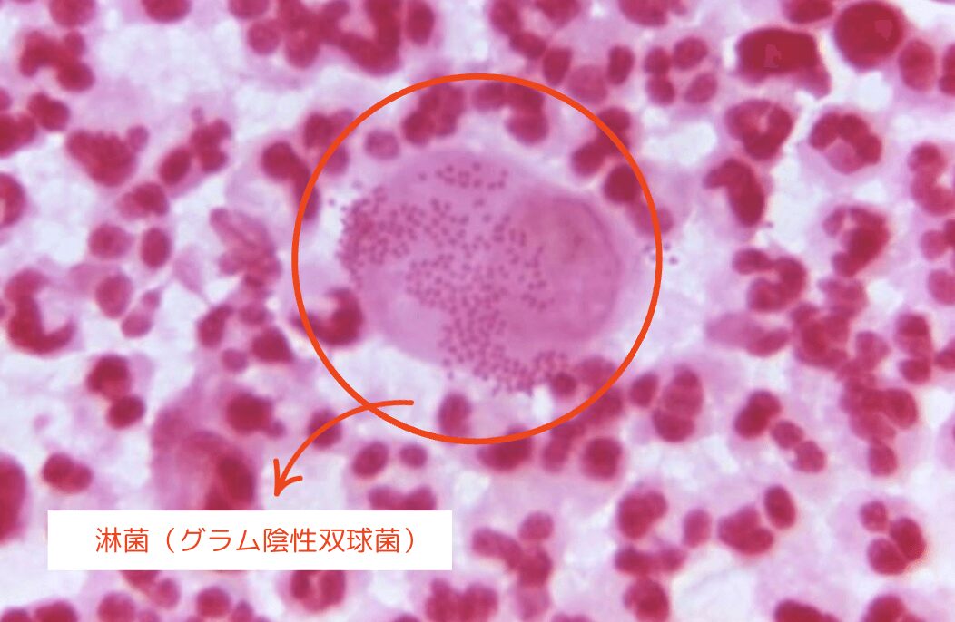 淋菌（グラム陰性双球菌）