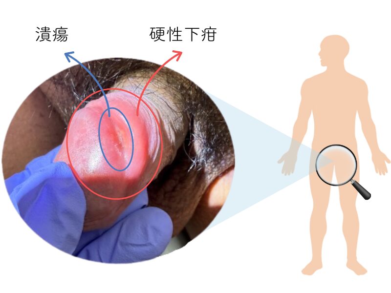 亀頭と陰茎の間の部分