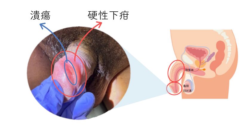 亀頭と陰茎の間の部分