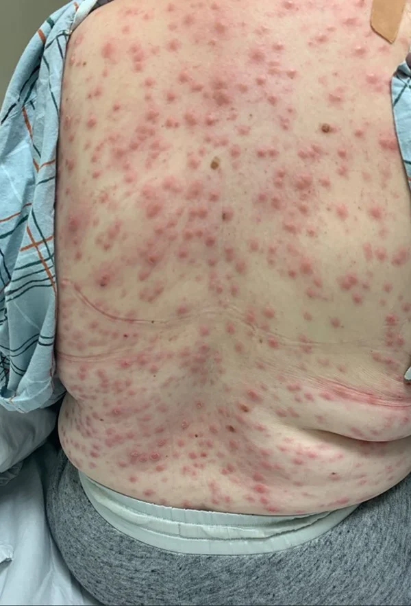 第二期梅毒（背中）