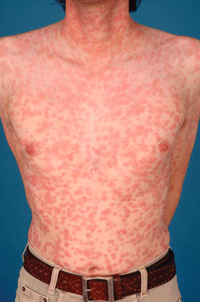 第二期梅毒（腹部）