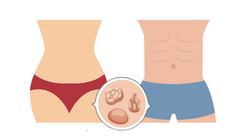 コンジローマの特徴