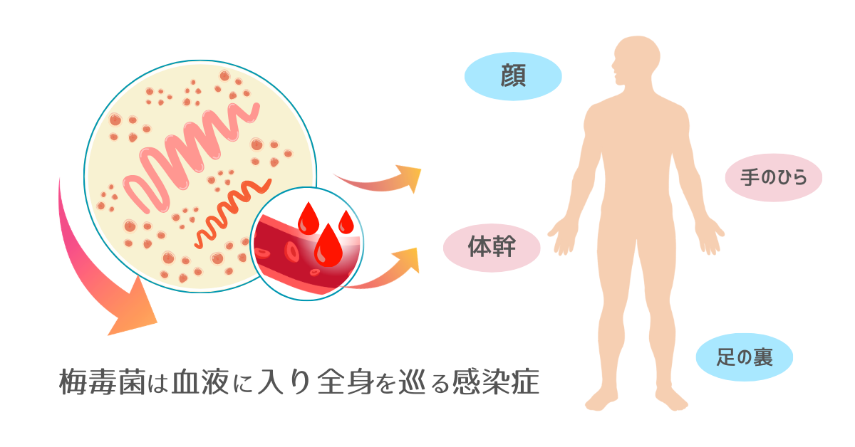 梅毒の原因となる梅毒トレポネーマ菌が血流を通じて全身に広がるイメージ図