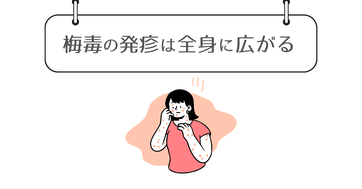 梅毒の発疹が全身に広がることを示した図