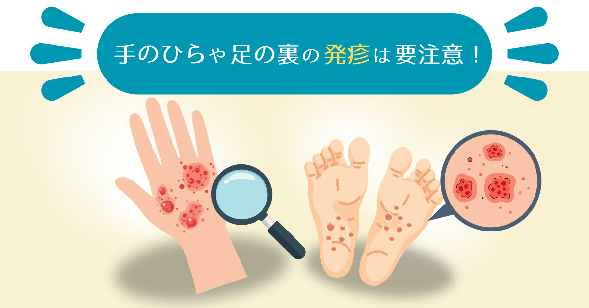 梅毒に特徴的な手のひらと足の裏に出る発疹のイメージ図