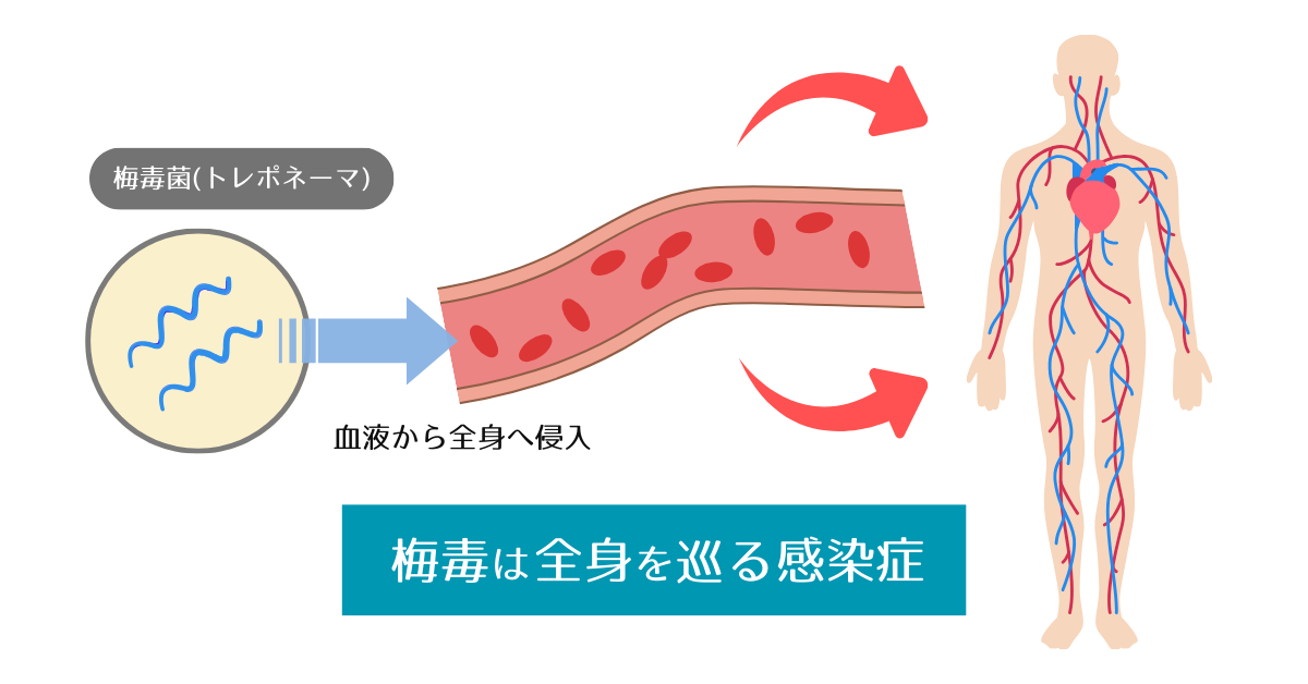 梅毒トレポネーマが体内に侵入し血液を通じて全身へ広がる仕組みのイラスト