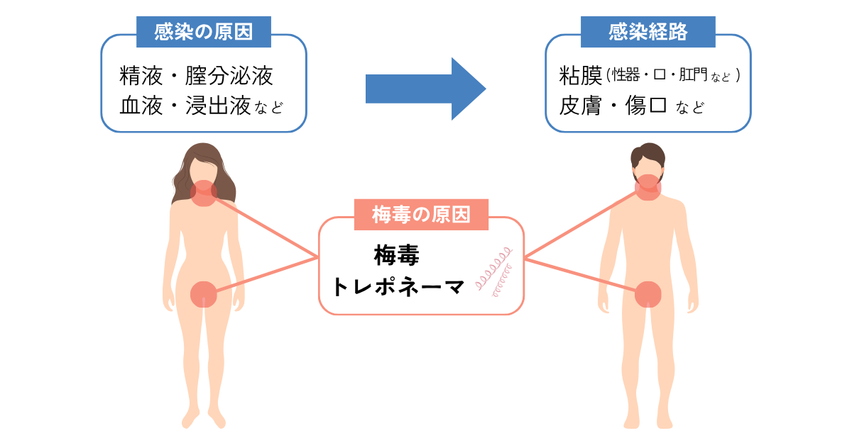 梅毒の感染経路や原因について説明するイラスト