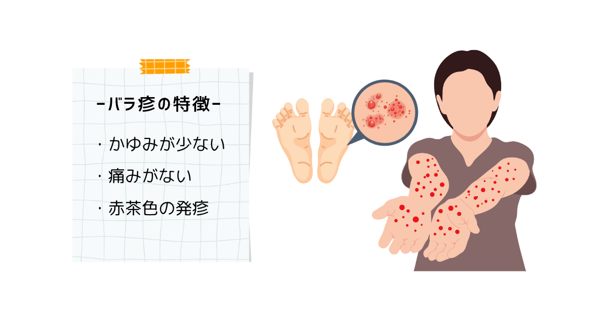 梅毒の第二期　バラ疹の特徴を説明するイラスト