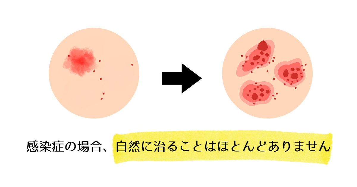 陰部 性器 かゆみ 悪化 放置 リスク